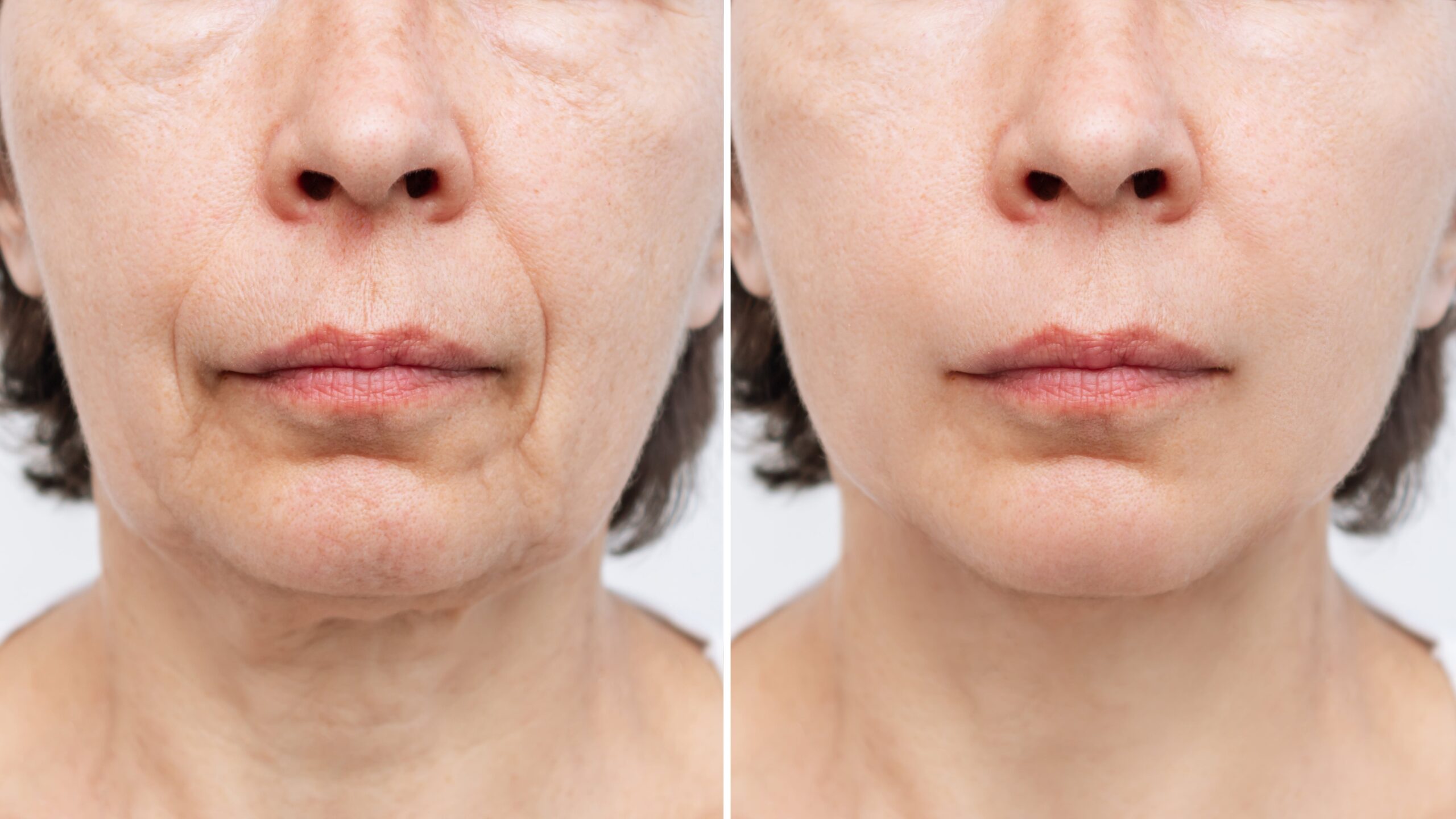 เปรียบเทียบผลลัพธ์ ก่อนและหลัง ฉีด Radiesse Filler