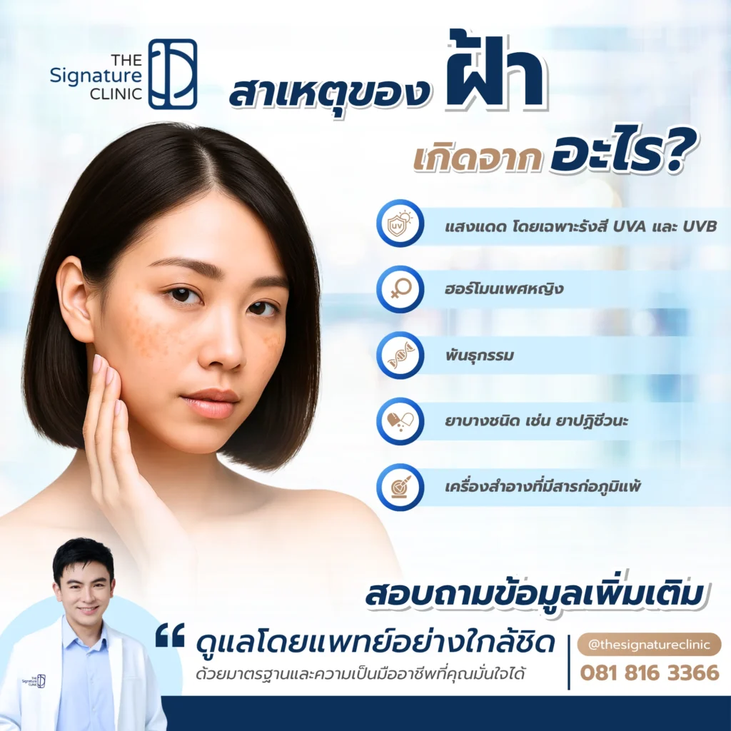 what causes melasma 2