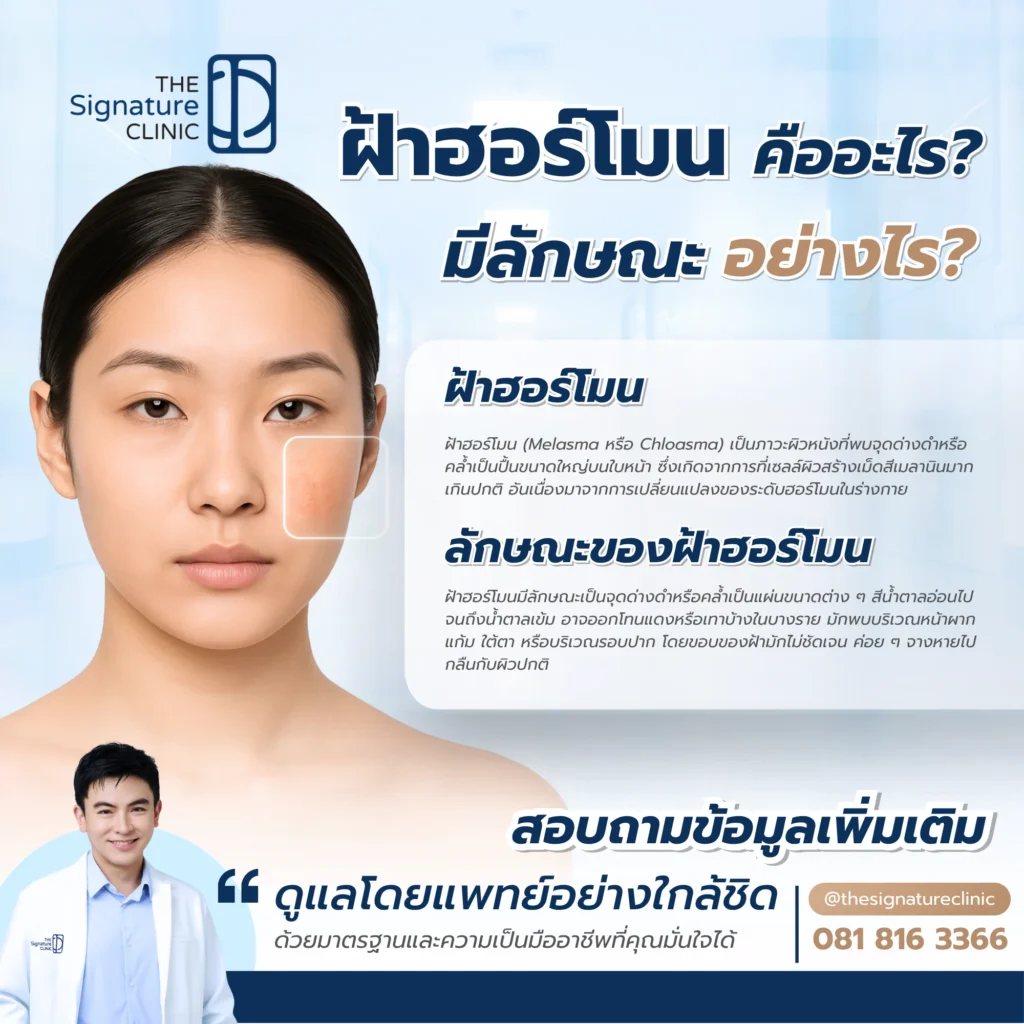 ฝ้าฮอร์โมน รักษายังไง 2