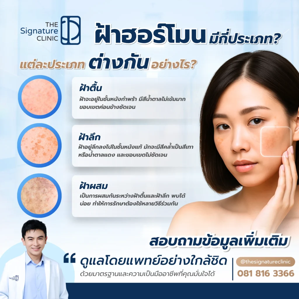 ฝ้าฮอร์โมน รักษายังไง 3