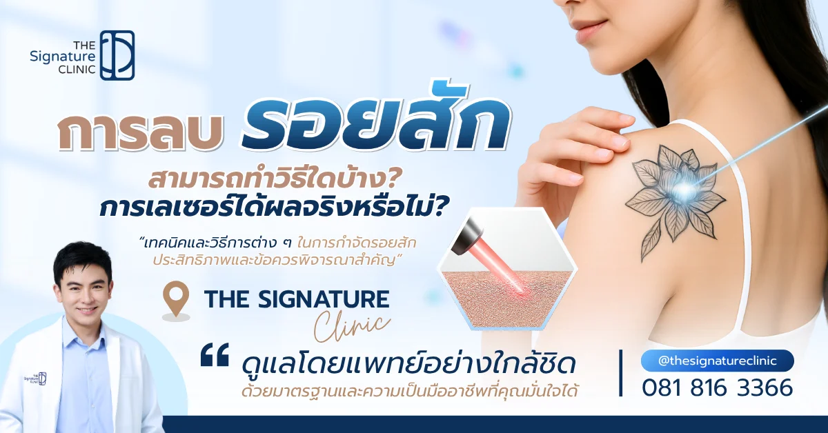 ลบรอยสัก