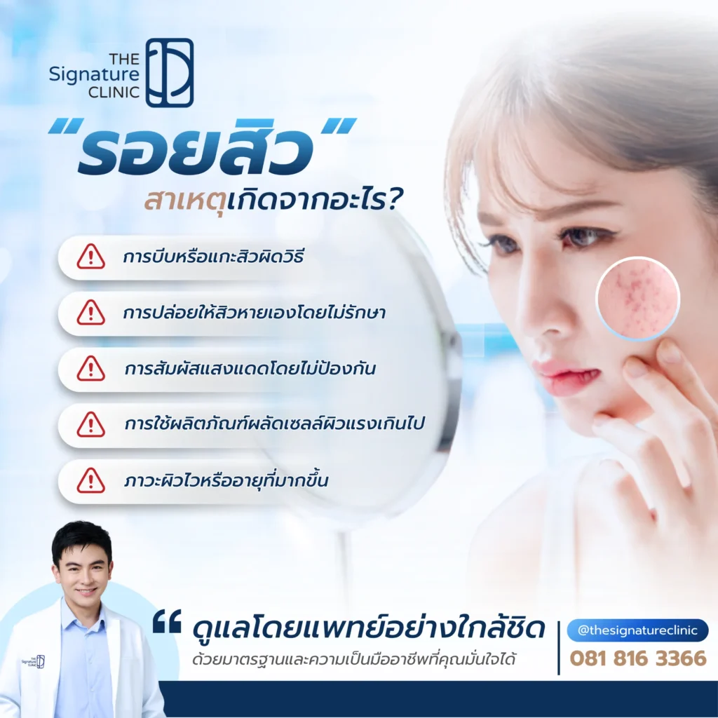 เลเซอร์รอยสิว