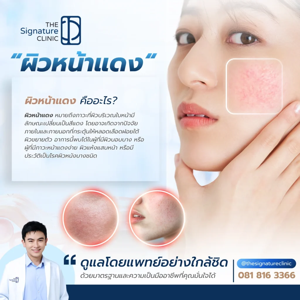 ผิวหน้าแดง