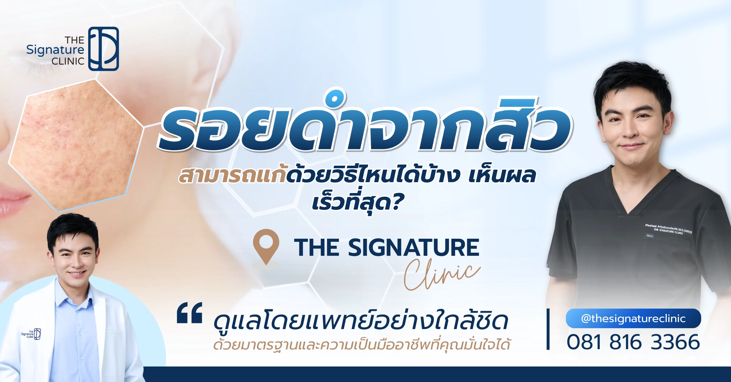 รอยดำจากสิว 1