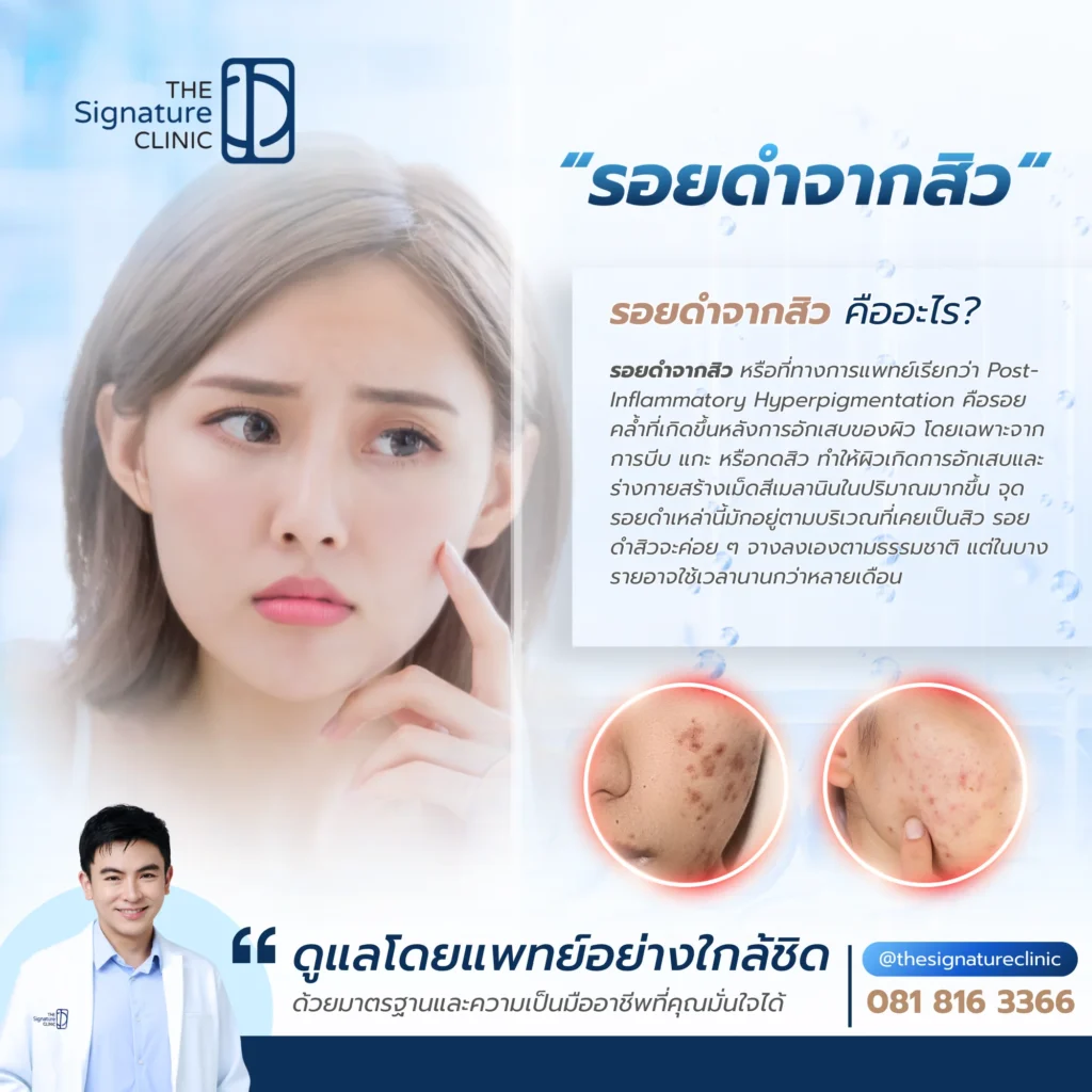 รอยดำจากสิว