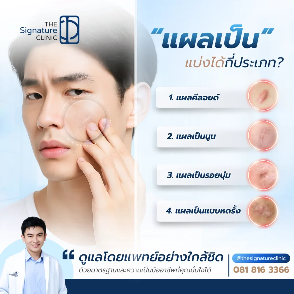 รักษาแผลเป็น