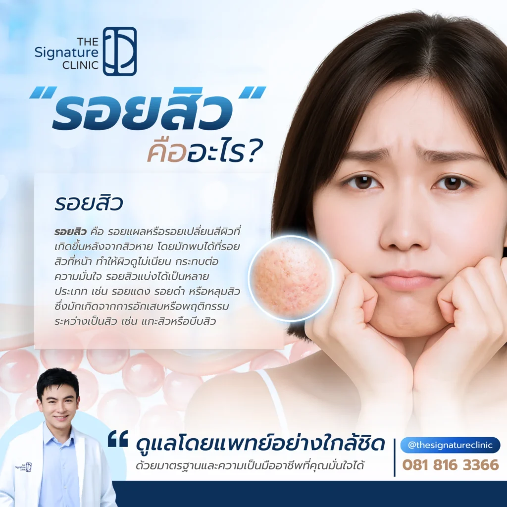 ลดรอยสิว