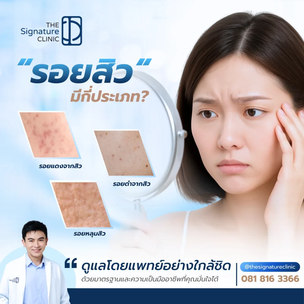 ลดรอยสิว