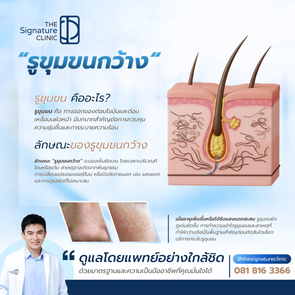 เลเซอร์กระชับรูขุมขน