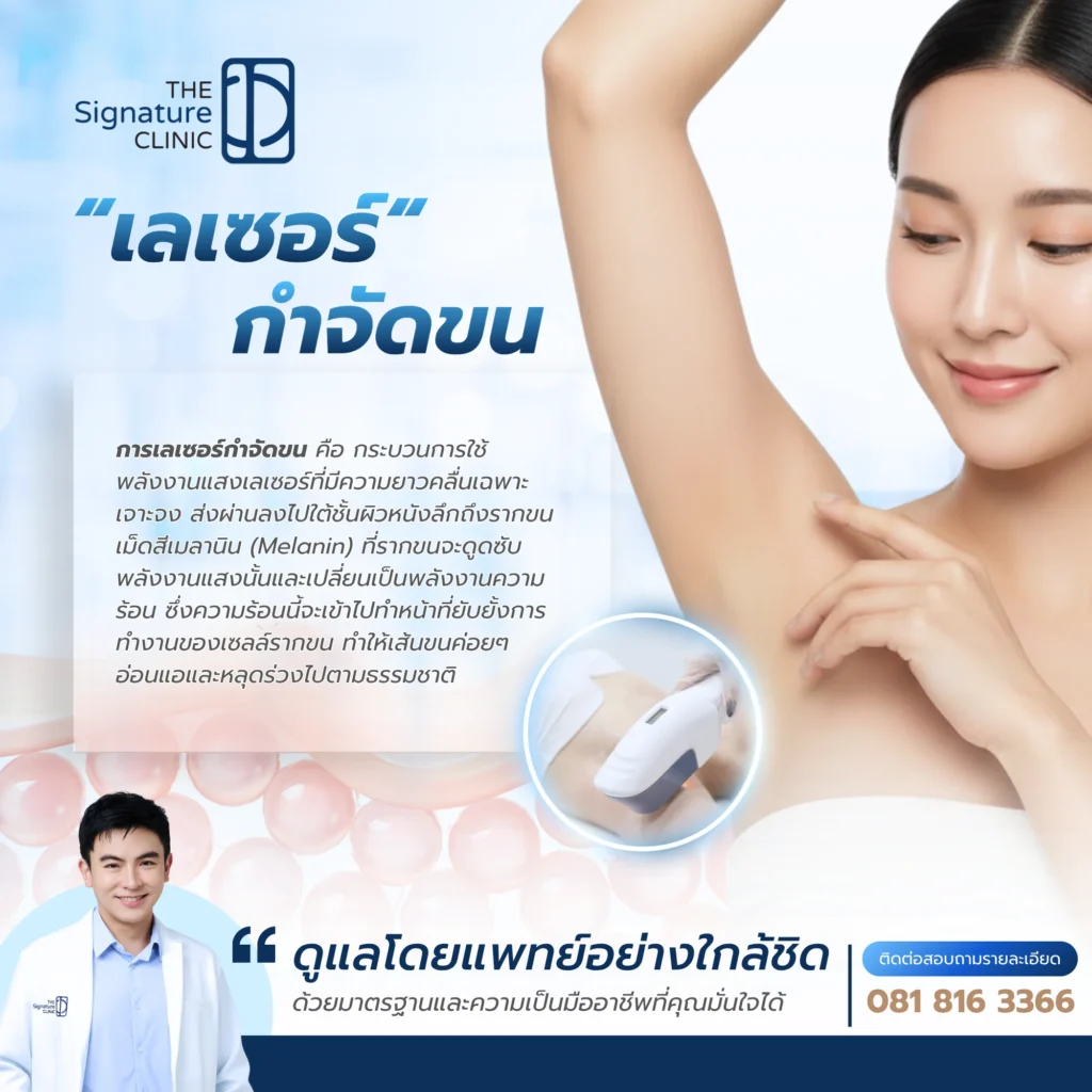 เลเซอร์กำจัดขน