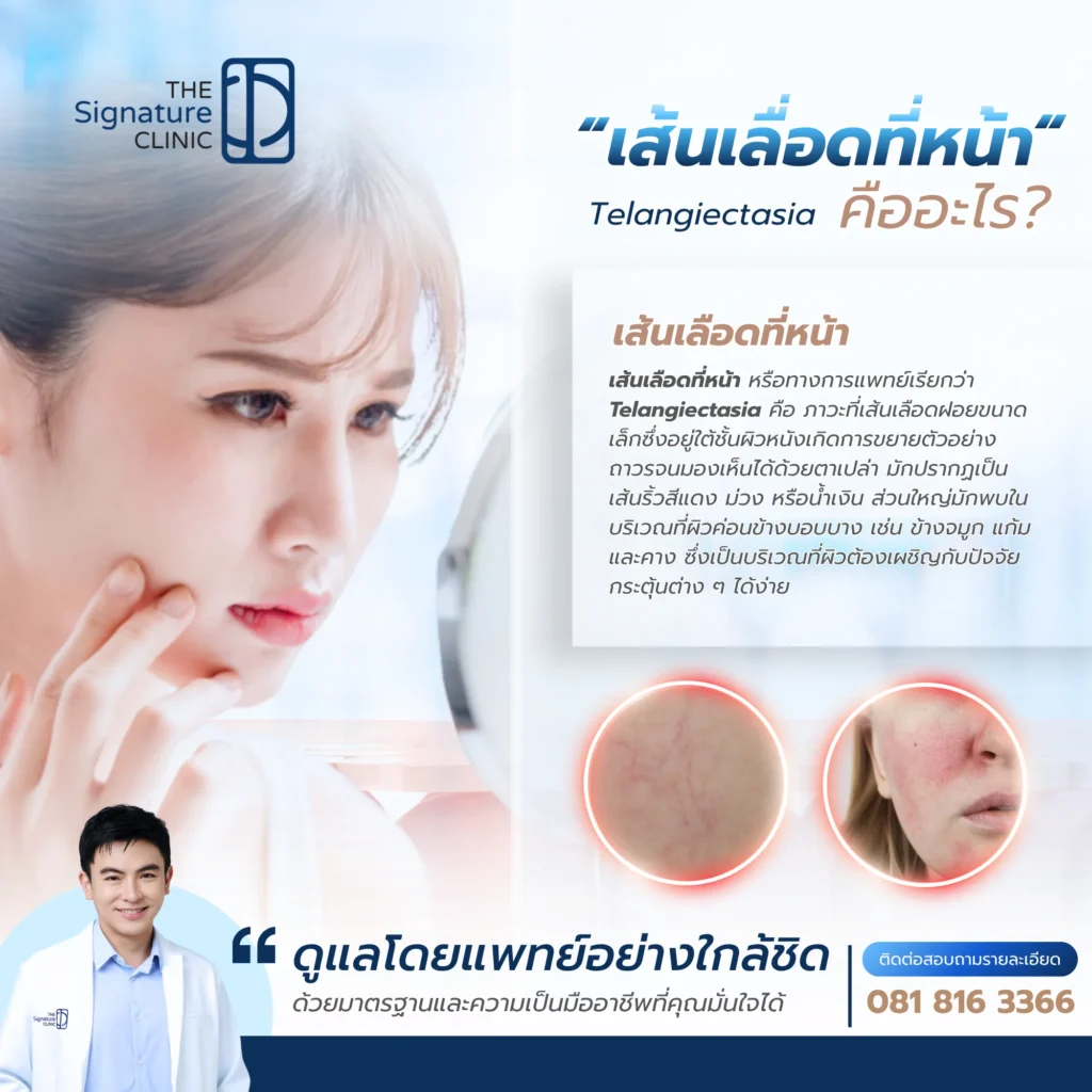 เส้นเลือดที่หน้า 2